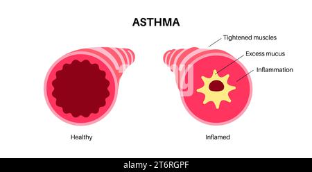 Asthma, Illustration Stockfoto