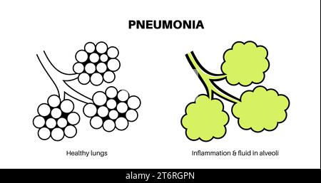 Pneumonie, Illustration Stockfoto