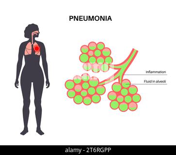 Pneumonie, Illustration Stockfoto