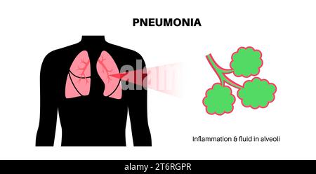 Pneumonie, Illustration Stockfoto