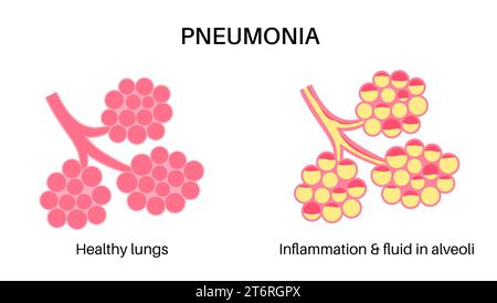 Pneumonie, Illustration Stockfoto