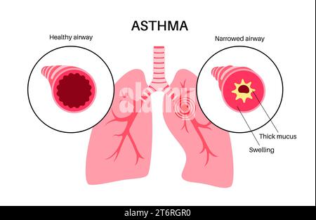 Asthma, Illustration Stockfoto