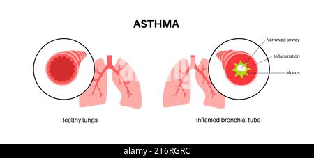 Asthma, Illustration Stockfoto