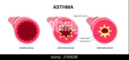 Asthma, Illustration Stockfoto