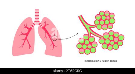 Pneumonie, Illustration Stockfoto