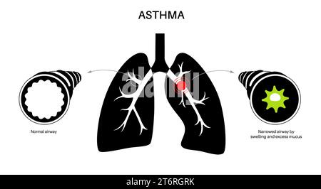 Asthma, Illustration Stockfoto