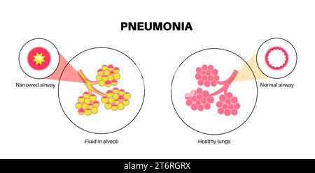 Pneumonie, Illustration Stockfoto