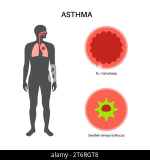 Asthma, Illustration Stockfoto