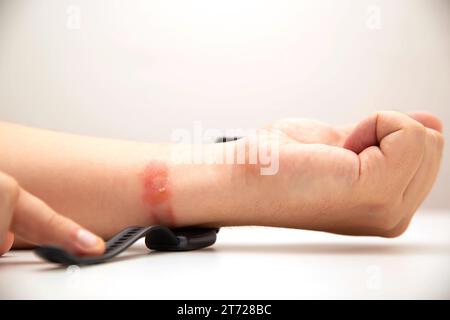 Rötungen und Allergien am Handgelenk einer Person durch das Tragen eines Fitnessarmbands mit Silikonband. Kontaktdermatitis Stockfoto