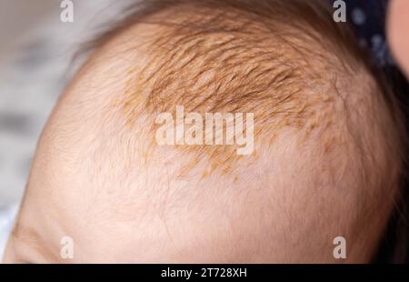 Der Entstehungsvorgang der seborrhoischen Dermatitis bei einem Säugling am Kopf. Schuppige Krusten. Stockfoto