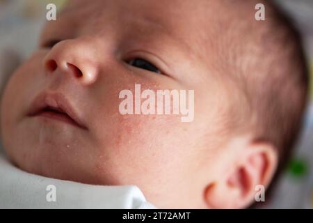 Pickel im Gesicht eines Neugeborenen. Babys Anpassung an die Umwelt. Stockfoto