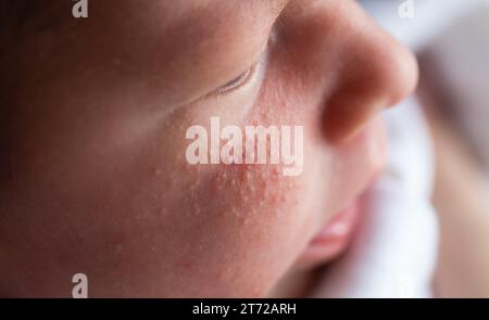 Allergische Pickel bei einem Neugeborenen im Gesicht. Pathogenese, Akne des Neugeborenen, Nahaufnahme Stockfoto