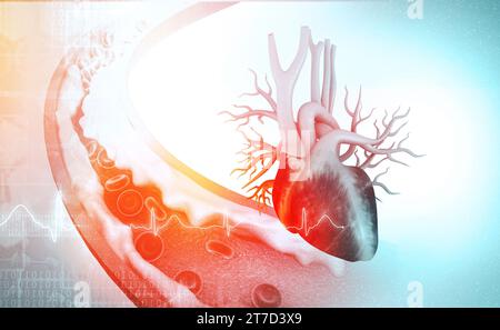 Cholesterinblockierte Arteria mit Herz. 3D-Abbildung Stockfoto