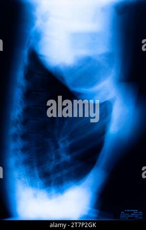 Ergebnis des Röntgenscans der Lungenrippen. Stockfoto
