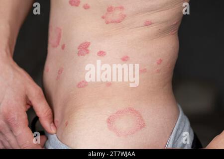 Psoriasis vulgaris, Hautflecken sind in der Regel rot, juckend und schuppig. Stockfoto