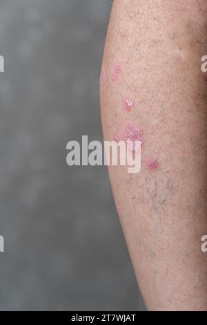 Psoriasis vulgaris, Hautflecken sind in der Regel rot, juckend und schuppig. Stockfoto