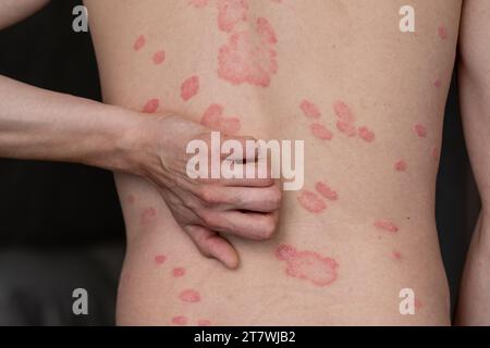 Psoriasis vulgaris, Hautflecken sind in der Regel rot, juckend und schuppig. Stockfoto