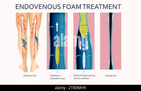 Krampfadern. Endovenöse Schaumbehandlung. Bei der Injektion in eine Vene verdrängt der Mikroschaum das Blut und sorgt so für besseren Kontakt mit der Venenwand. Stockfoto