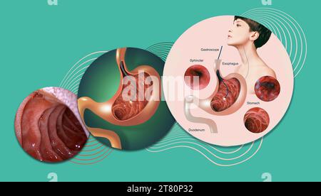 Verdauungsendoskopie oder Gastroskopie. Durchführung einer Gastroskopie. Diagnostik von Magenerkrankungen. Magengesundheit. Medizinisches Konzept Stockfoto