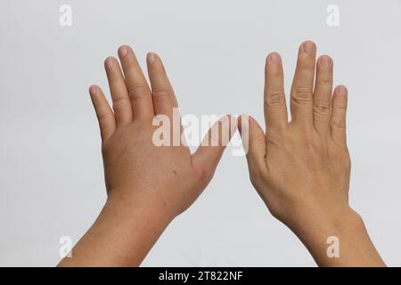 Geschwollene Hand durch allergische Insektenstiche. Hautallergische Pflege. Stockfoto
