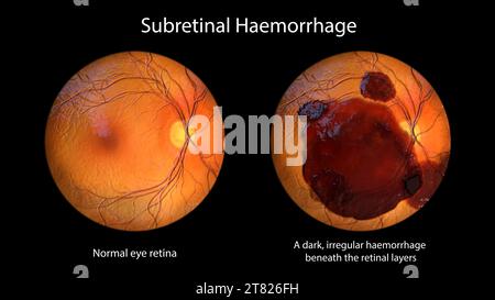 Subretinale Netzhautblutung, Illustration Stockfoto