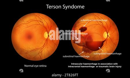 Intraokulare Blutung bei Terson-Syndrom, Illustration Stockfoto