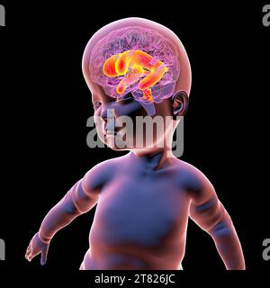 Baby mit vergrösserten lateralen Ventrikeln, Illustration Stockfoto