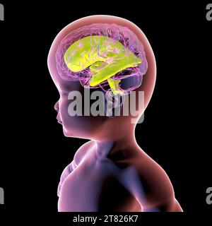 Baby mit vergrößerten Hirnventrikeln, Illustration Stockfoto
