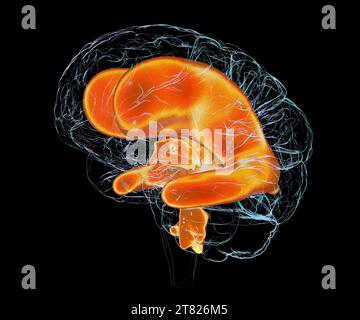 Vergrößerte Ventrikel des kindlichen Gehirns, Illustration Stockfoto