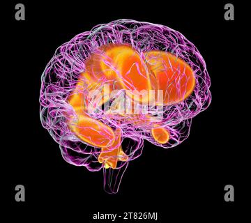 Vergrößerte Ventrikel des kindlichen Gehirns, Illustration Stockfoto