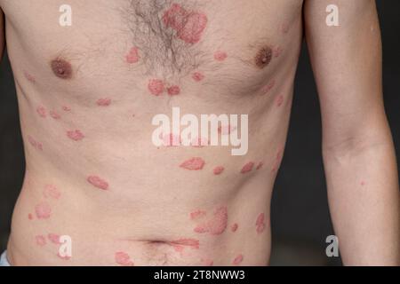 Psoriasis vulgaris, Hautflecken sind in der Regel rot, juckend und schuppig. Stockfoto