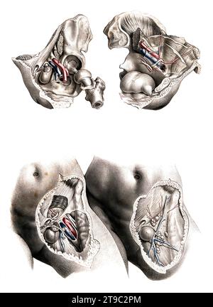 Medizin, menschliche Anatomie, Femoralhernie, Schenkelbruch, auch Femoralhernie genannt, bezeichnet Bruchlücken unmittelbar unterhalb des sogenannten Leistenbandes. Der Schenkelbruch tritt auf, wo die großen Blutgefäße des Beines in die Bauchhöhle treten. Kolorierte Lithographie von J. Maclise, 1841/1844, Historisch, digital restaurierte Reproduktion von einer Vorlage aus dem 19. Jahrhundert / Medizin, menschliche Anatomie, Femurhernie, Femurhernie, auch Femurhernie genannt, bezieht sich auf Hernienlücken direkt unterhalb des sogenannten Leistenbandes. Die Femoralhernie tritt dort auf, wo die große Blume auftritt Stockfoto