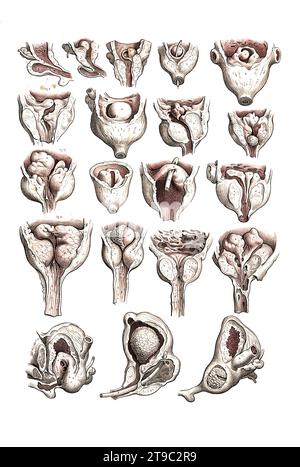 Menschliche Anatomie, Medizin, Chirurgische Eingriffe an der Prostata in verschiedenen Stellungen. Kolorierte Lithographie von J. Maclise, 1841/1844, Historisch, digital restaurierte Reproduktion von einer Vorlage aus dem 19. Jahrhundert / menschliche Anatomie, Medizin, chirurgische Eingriffe an der Prostata in verschiedenen Positionen. Farbige Lithographie von J. Maclise, 1841/1844, historisch, digital restaurierte Reproduktion eines Originals aus dem 19. Jahrhundert Stockfoto