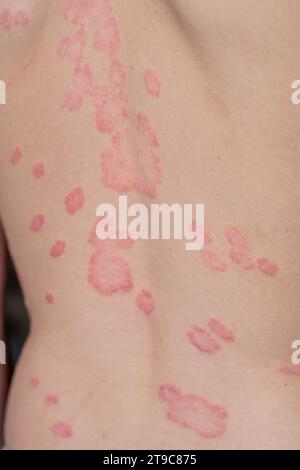 Psoriasis vulgaris, Hautflecken sind in der Regel rot, juckend und schuppig. Stockfoto