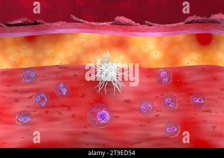 Entzündliche Haut bei Ekzem, atopischer Dermatitis (AD) - Vorderansicht 3D-Illustration Stockfoto