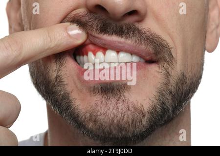 Mann mit entzündetem Kaugummi auf weißem Hintergrund, Nahaufnahme Stockfoto