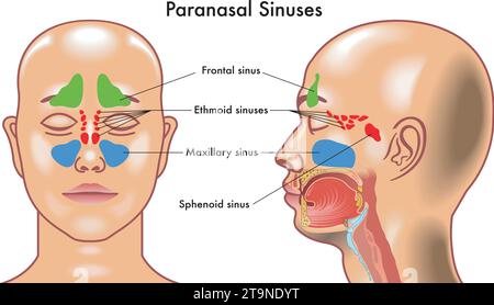 Medizinische Darstellung der Symptome der Sinusitis. Stock Vektor