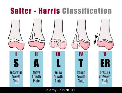 Salter - Harris-Klassifikation zur Erkennung und Identifizierung verschiedener Arten von Knochenfrakturen. Illustration für Schüler Stockfoto