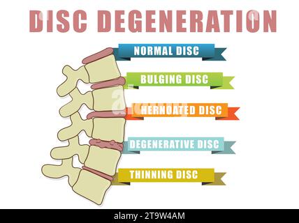 Bandscheibendegenerationsdiagramm mit Zustandsbeispielen - Ausbuchtung, Hernoierung, degenerative und dünnflüssige Bandscheibe. Pädagogische medizinische Information. Abbildung Stockfoto