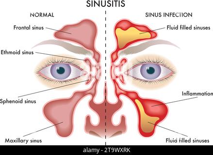 Medizinische Darstellung der Symptome der Sinusitis. Stock Vektor