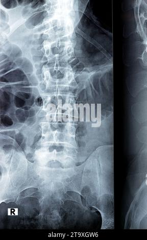 Die digitale Röntgenuntersuchung der Lumbosakralen Wirbelsäule zeigt eine begradigte lordotische Kurve der Lumbosakralwirbelsäule und eine marginale osteophytische Lippung der L4-Endplatte Stockfoto