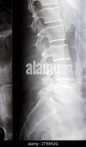 Die digitale Röntgenuntersuchung der Lumbosakralen Wirbelsäule zeigt eine begradigte lordotische Kurve der Lumbosakralwirbelsäule und eine marginale osteophytische Lippung der L4-Endplatte Stockfoto