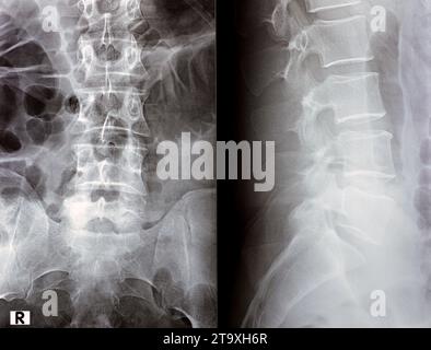 Die digitale Röntgenuntersuchung der Lumbosakralen Wirbelsäule zeigt eine begradigte lordotische Kurve der Lumbosakralwirbelsäule und eine marginale osteophytische Lippung der L4-Endplatte Stockfoto