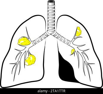 Humane Lungen mit Krebs. Symbol mit schwarzer Linie. Einfacher Umrissstil. Stilisiertes Piktogramm für Webdesign oder mobile App. Vektorabbildung. Symbol für flache Linie Stock Vektor