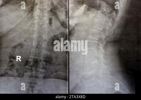 Das einfache Röntgenbild der dorsalen und der Holzwirbelsäule zeigt spondylotische Veränderungen, die Begradigung der dorsalen und der Holzwirbelsäule, die Bandscheibenräume sind intakt, Stockfoto