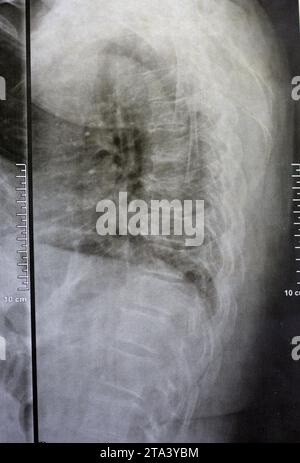 Das einfache Röntgenbild der dorsalen und der Holzwirbelsäule zeigt spondylotische Veränderungen, die Begradigung der dorsalen und der Holzwirbelsäule, die Bandscheibenräume sind intakt, Stockfoto