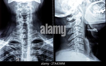 Die Röntgenaufnahme der Halswirbelsäule zeigte eine begradigte Halswirbelkurve, Spondylose osteophytische Lippen der Endplatten C3, C4, C5, schmale Bandscheibe sp Stockfoto