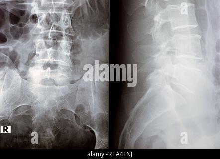 Die digitale Röntgenuntersuchung der Lumbosakralen Wirbelsäule zeigt eine begradigte lordotische Kurve der Lumbosakralwirbelsäule und eine marginale osteophytische Lippung der L4-Endplatte Stockfoto