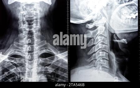 Die Röntgenaufnahme der Halswirbelsäule zeigte eine begradigte Halswirbelkurve, Spondylose osteophytische Lippen der Endplatten C3, C4, C5, schmale Bandscheibe sp Stockfoto