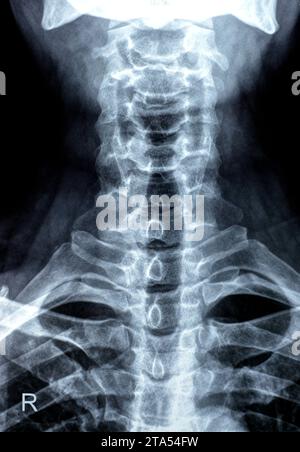 Die Röntgenaufnahme der Halswirbelsäule zeigte eine begradigte Halswirbelkurve, Spondylose osteophytische Lippen der Endplatten C3, C4, C5, schmale Bandscheibe sp Stockfoto